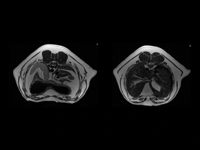 T2W abdomna psa z respiratornim proženjem